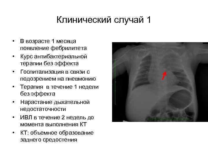 Клинический случай 1 • В возрасте 1 месяца появление фебрилитета • Курс антибактериальной терапии