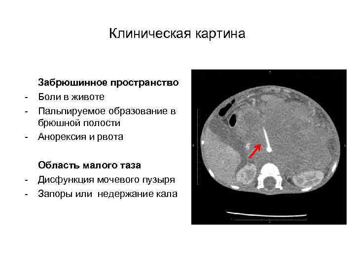 Клиническая картина - Забрюшинное пространство Боли в животе Пальпируемое образование в брюшной полости Анорексия