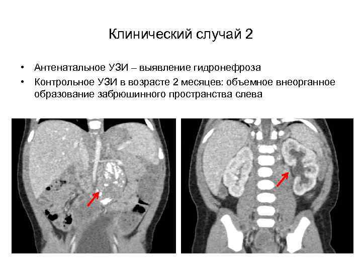 Клинический случай 2 • Антенатальное УЗИ – выявление гидронефроза • Контрольное УЗИ в возрасте