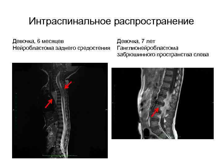 Интраспинальное распространение Девочка, 6 месяцев Нейробластома заднего средостения Девочка, 7 лет Ганглионейробластома забрюшинного пространства