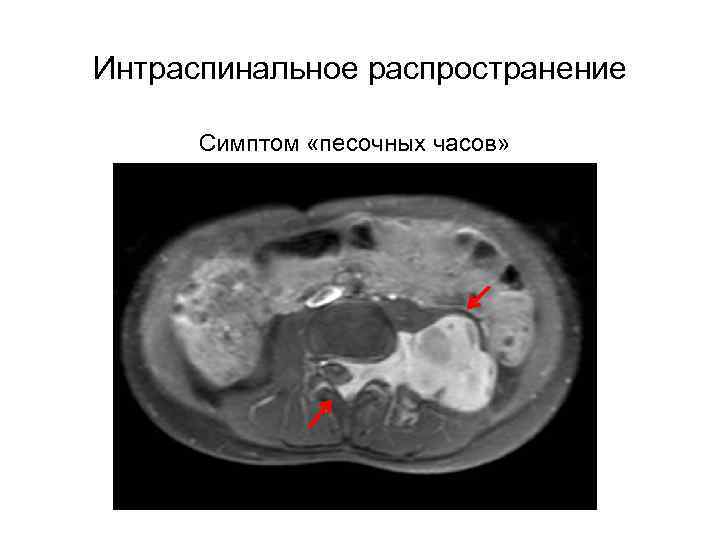 Интраспинальное распространение Симптом «песочных часов» 