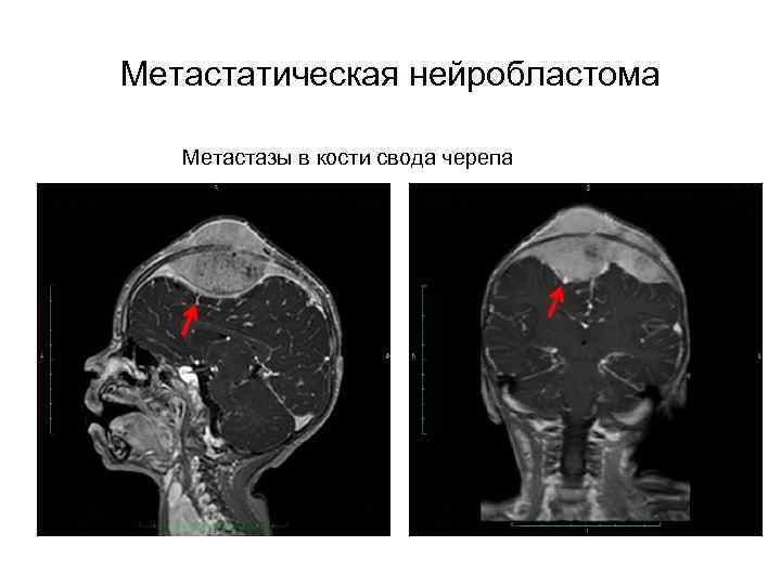 Метастатическая нейробластома Метастазы в кости свода черепа 