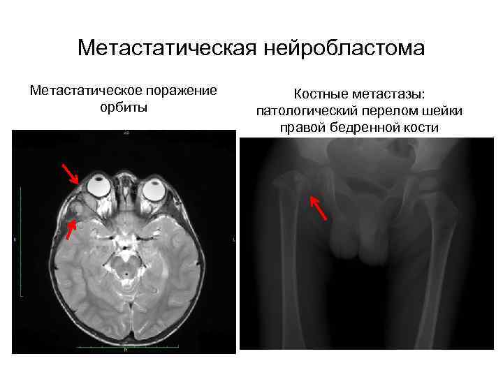 Метастатическая нейробластома Метастатическое поражение орбиты Костные метастазы: патологический перелом шейки правой бедренной кости 