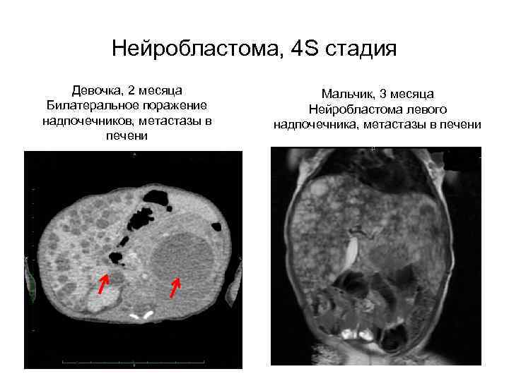 Нейробластома, 4 S стадия Девочка, 2 месяца Билатеральное поражение надпочечников, метастазы в печени Мальчик,