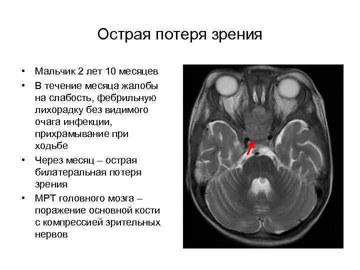 Острая потеря зрения • Мальчик 2 лет 10 месяцев • В течение месяца жалобы