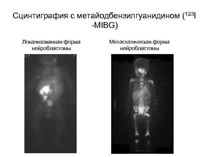 Сцинтиграфия с метайодбензилгуанидином (123 I -MIBG) Локализованная форма нейробластомы Метастатическая форма нейробластомы 