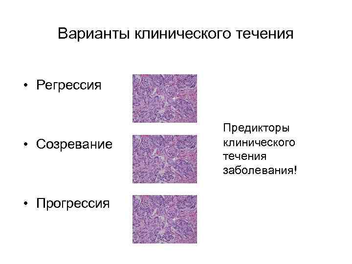 Варианты клинического течения • Регрессия • Созревание • Прогрессия Предикторы клинического течения заболевания! 