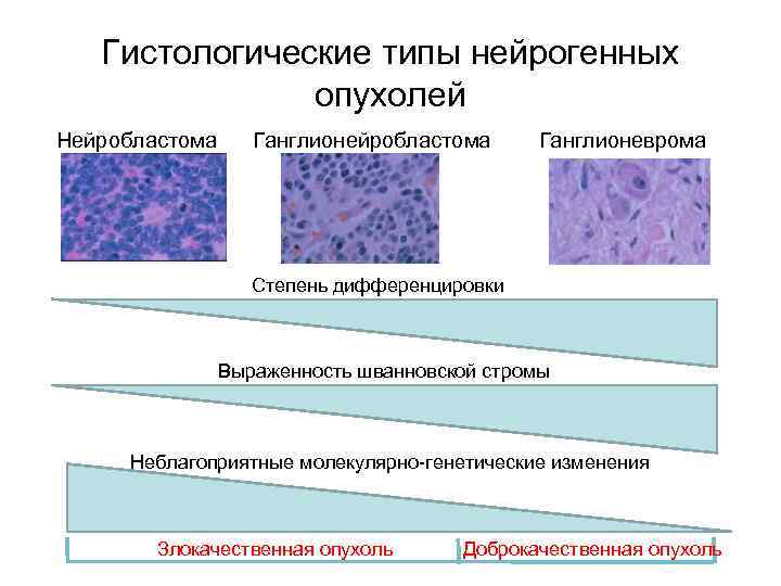 Гистологические типы нейрогенных опухолей Нейробластома Ганглионеврома Степень дифференцировки Выраженность шванновской стромы Неблагоприятные молекулярно-генетические изменения