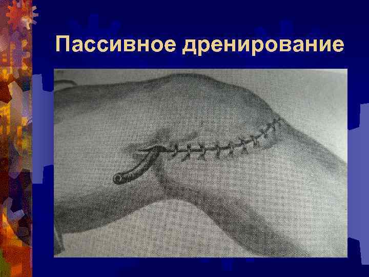 Пассивное дренирование 