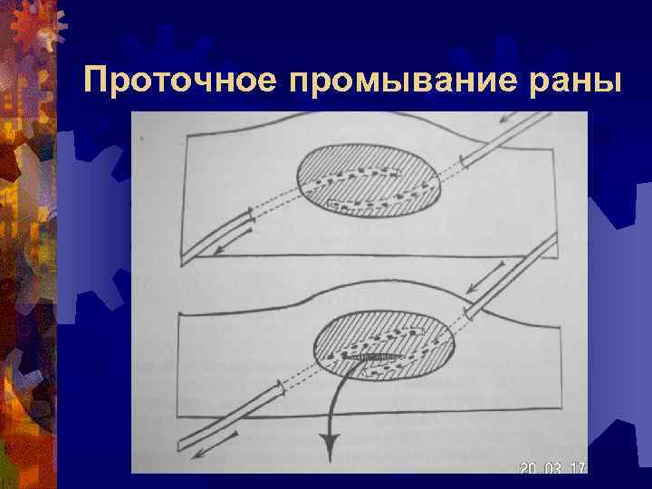 Проточное промывание раны 