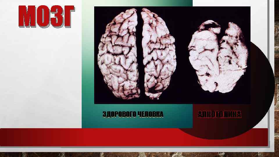 МОЗГ ЗДОРОВОГО ЧЕЛОВКА АЛКОГОЛИКА 