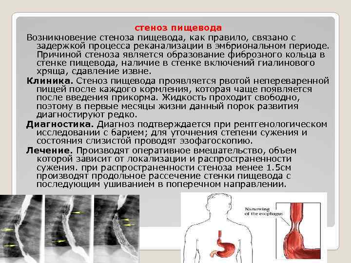 стеноз пищевода Возникновение стеноза пищевода, как правило, связано с задержкой процесса реканализации в эмбриональном