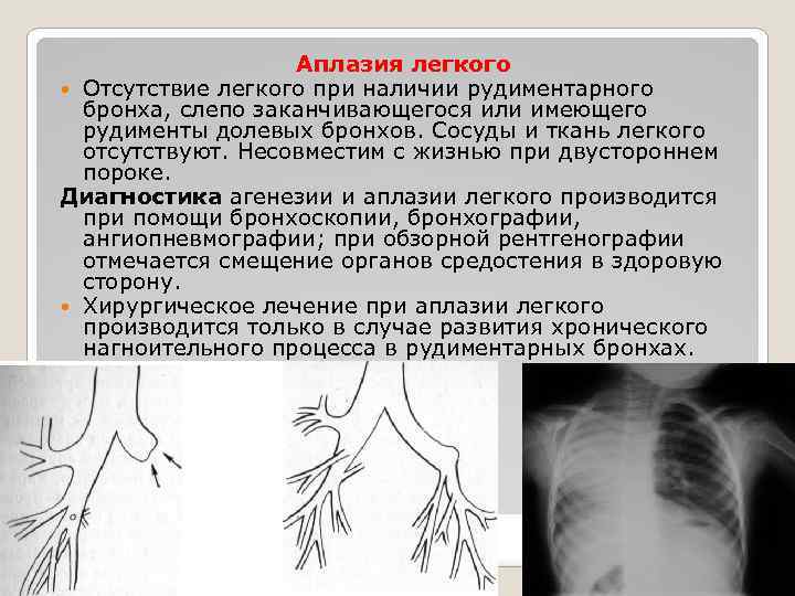 Аплазия легкого Отсутствие легкого при наличии рудиментарного бронха, слепо заканчивающегося или имеющего рудименты долевых