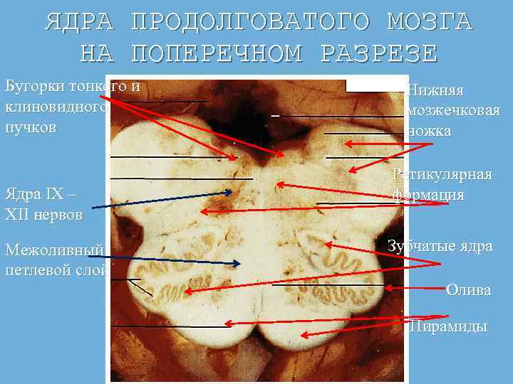 ЯДРА ПРОДОЛГОВАТОГО МОЗГА НА ПОПЕРЕЧНОМ РАЗРЕЗЕ Бугорки тонкого и клиновидного пучков Ядра IX –