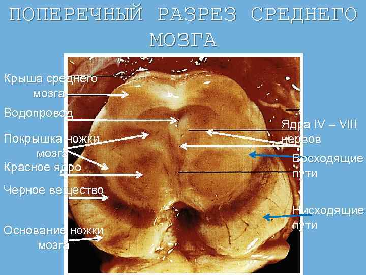 ПОПЕРЕЧНЫЙ РАЗРЕЗ СРЕДНЕГО МОЗГА Крыша среднего мозга Водопровод Покрышка ножки мозга Красное ядро Ядра