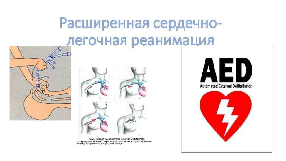 Расширенная сердечнолегочная реанимация 