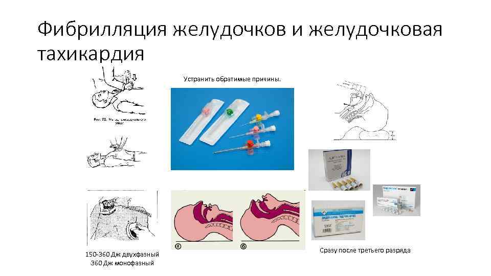 Фибрилляция желудочков и желудочковая тахикардия Устранить обратимые причины. 150 -360 Дж двухфазный 360 Дж