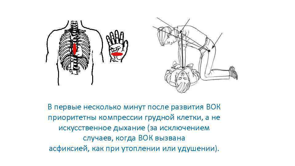 В первые несколько минут после развития ВОК приоритетны компрессии грудной клетки, а не искусственное