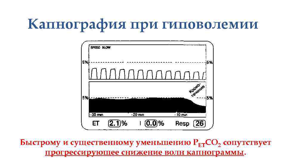 Капнография при гиповолемии Быстрому и существенному уменьшению РЕТСО 2 сопутствует прогрессирующее снижение волн капнограммы.