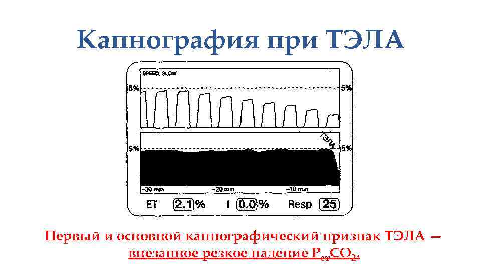 Капнография при ТЭЛА Первый и основной капнографический признак ТЭЛА — внезапное резкое падение Рет.