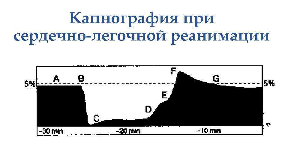 Капнография при сердечно-легочной реанимации 