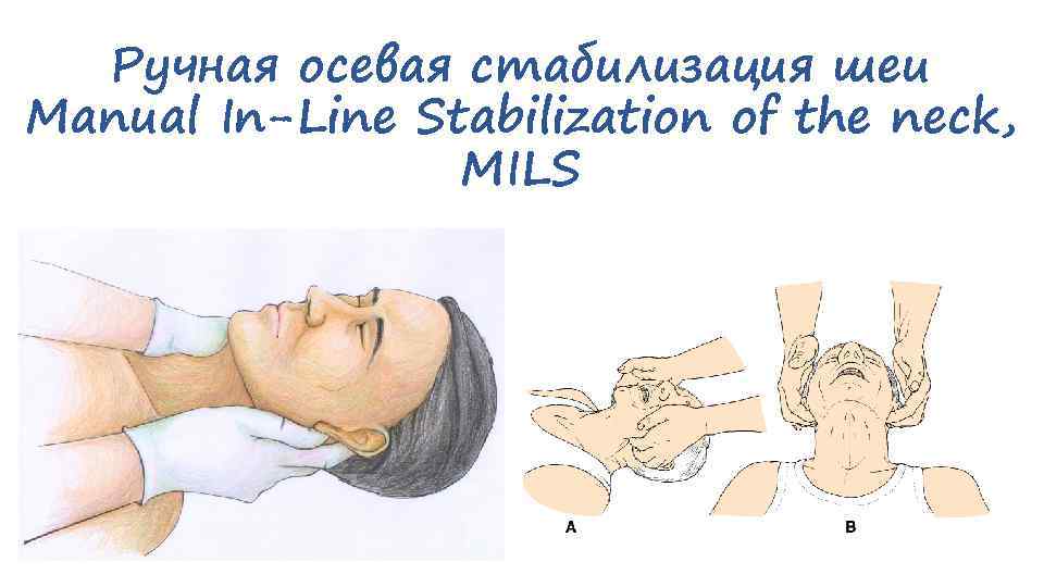 Ручная осевая стабилизация шеи Manual In-Line Stabilization of the neck, MILS 