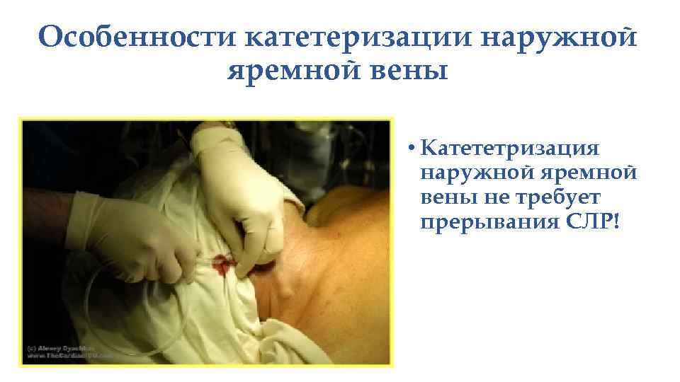 Особенности катетеризации наружной яремной вены • Катететризация наружной яремной вены не требует прерывания СЛР!