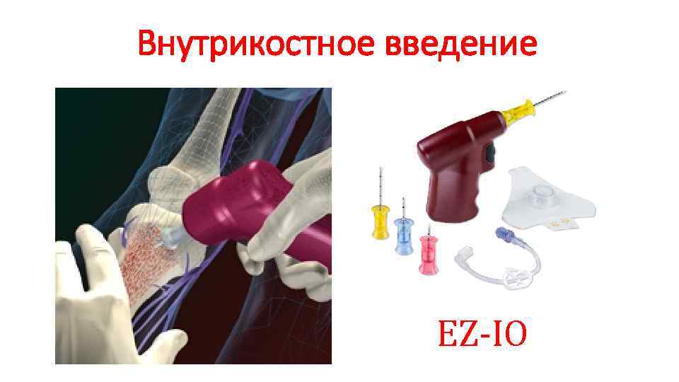 Внутрикостное введение EZ-IO 