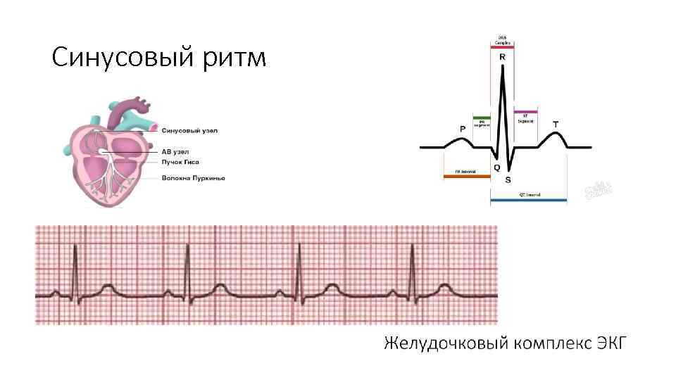 Синусовый ритм 