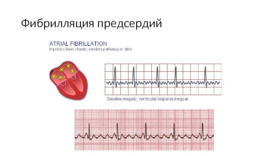 Фибрилляция предсердий 