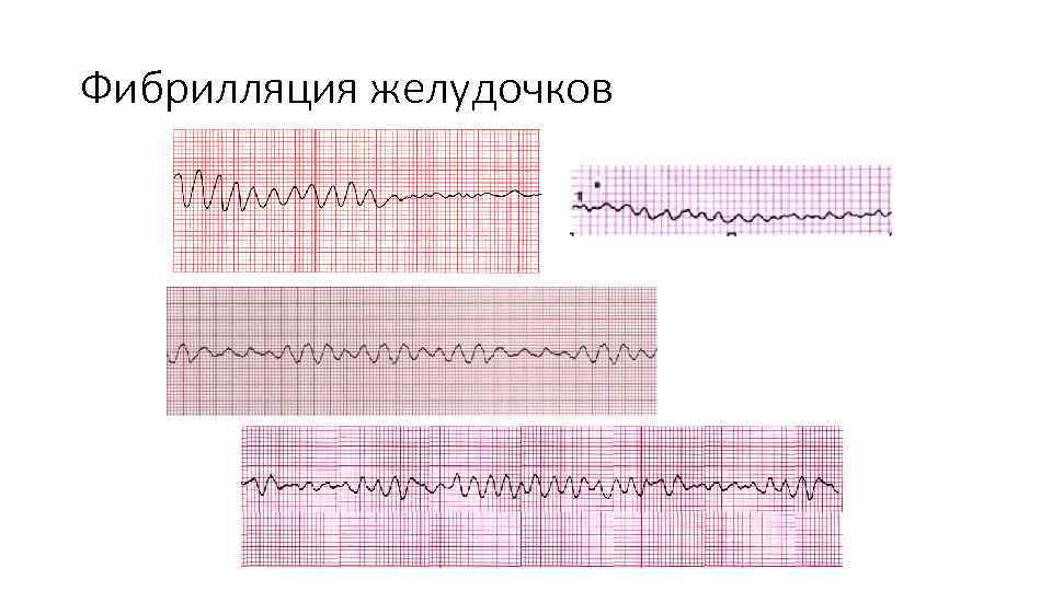 Фибрилляция желудочков 
