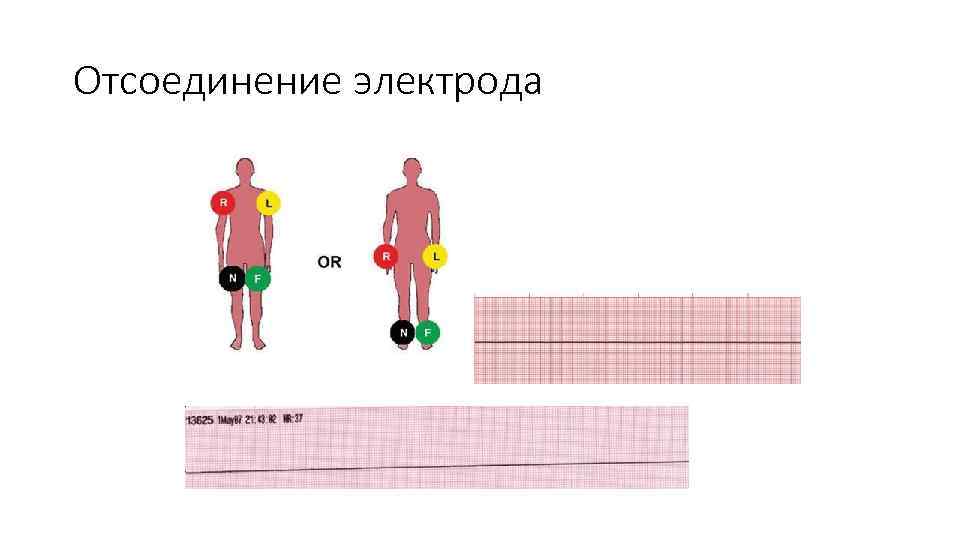 Отсоединение электрода 