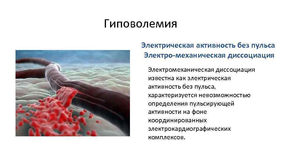 Гиповолемия Электрическая активность без пульса Электро-механическая диссоциация Электромеханическая диссоциация известна как электрическая активность без