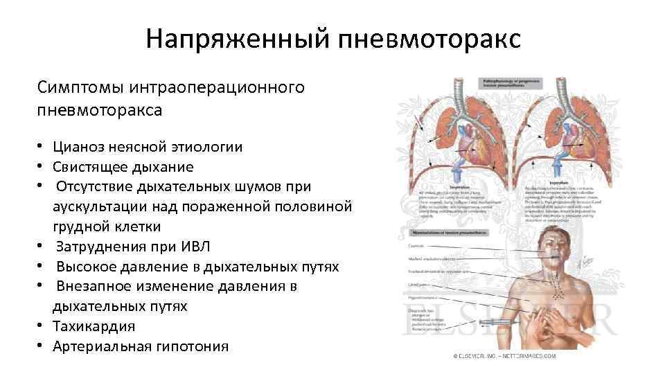 Напряженный пневмоторакс Симптомы интраоперационного пневмоторакса • Цианоз неясной этиологии • Свистящее дыхание • Отсутствие