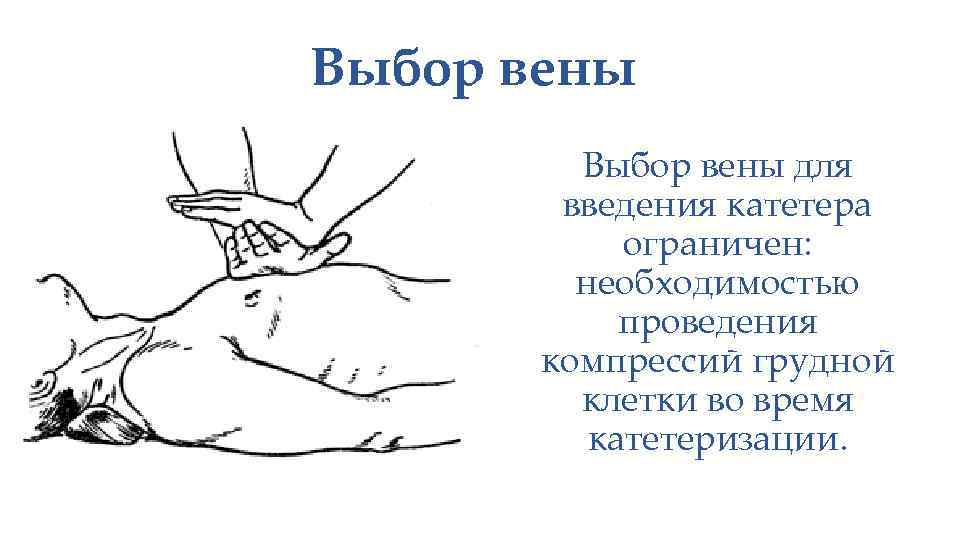 Выбор вены для введения катетера ограничен: необходимостью проведения компрессий грудной клетки во время катетеризации.