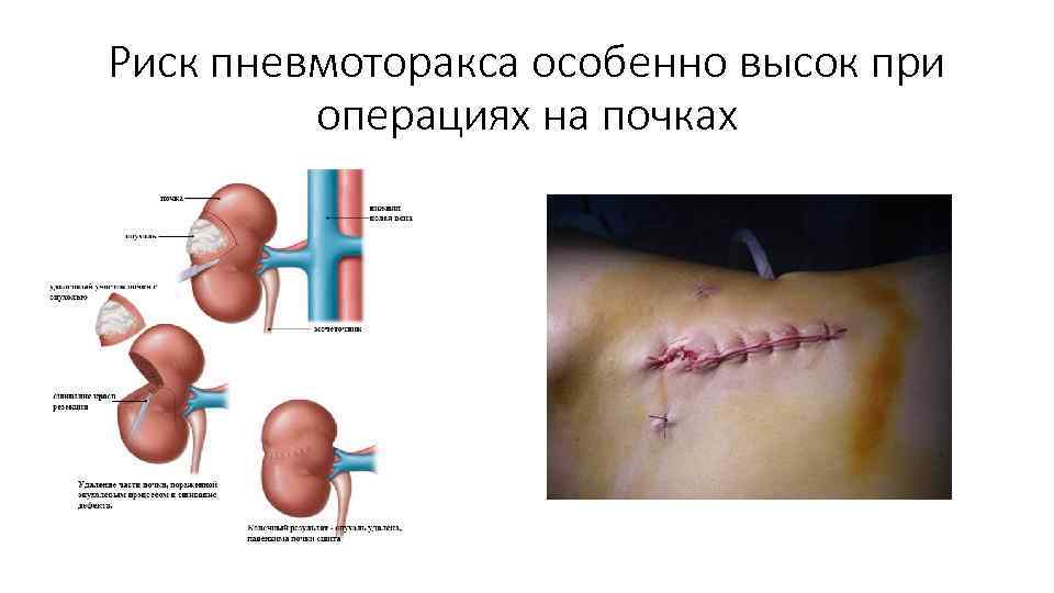 Риск пневмоторакса особенно высок при операциях на почках 