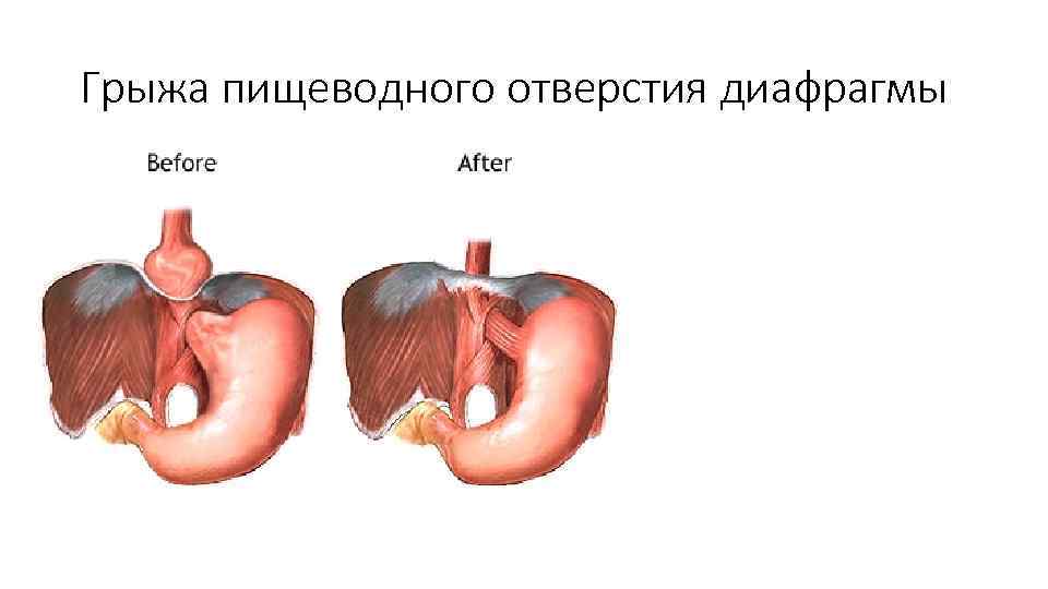 Грыжа пищеводного отверстия диафрагмы 