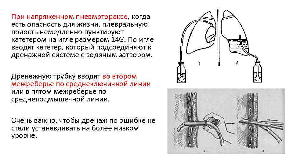 При напряженном пневмотораксе, когда есть опасность для жизни, плевральную полость немедленно пунктируют катетером на