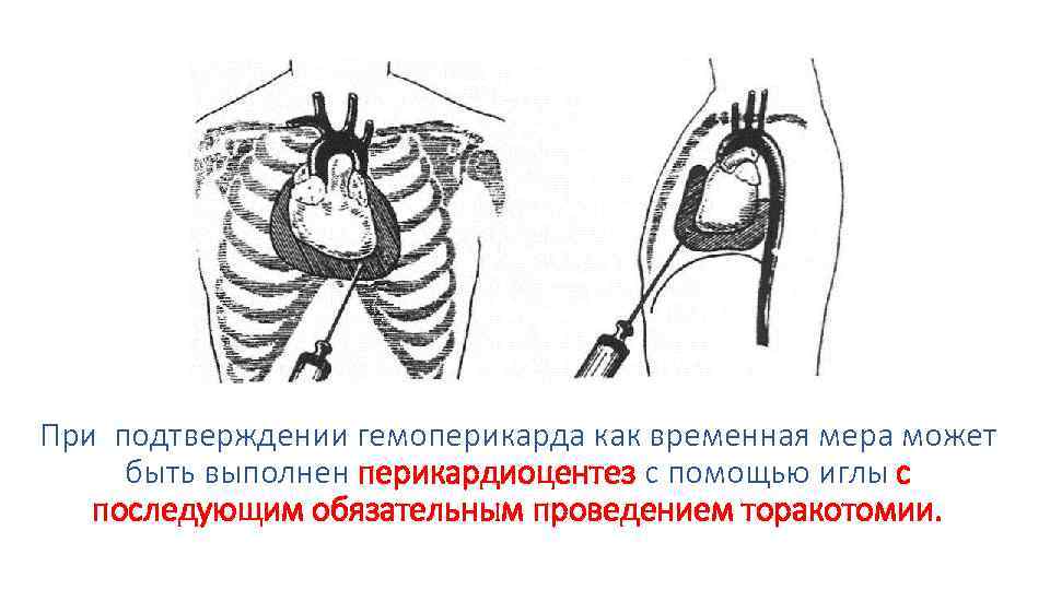 При подтверждении гемоперикарда как временная мера может быть выполнен перикардиоцентез с помощью иглы с