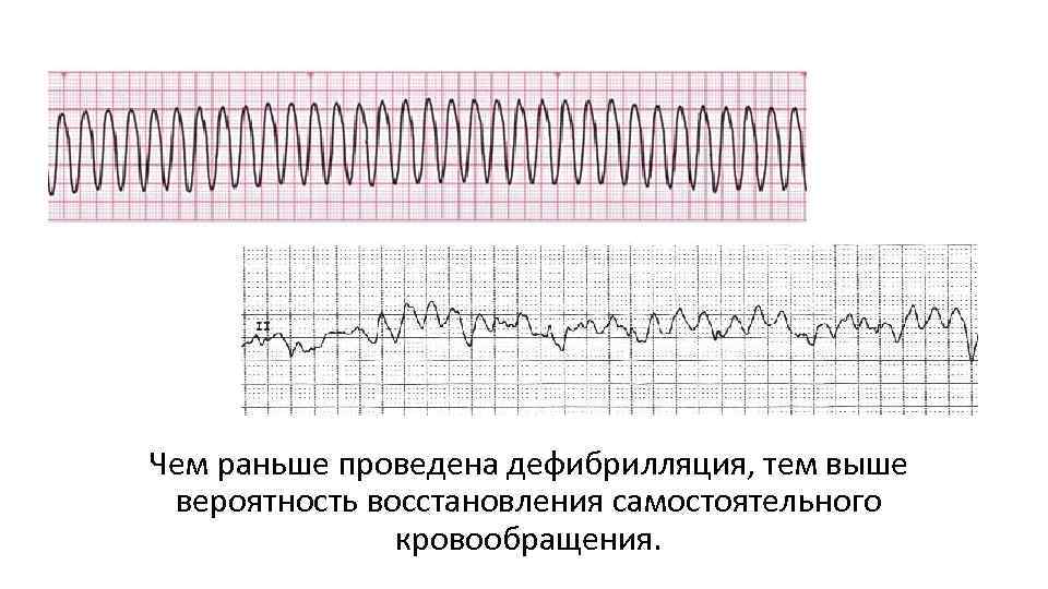 Чем раньше проведена дефибрилляция, тем выше вероятность восстановления самостоятельного кровообращения. 