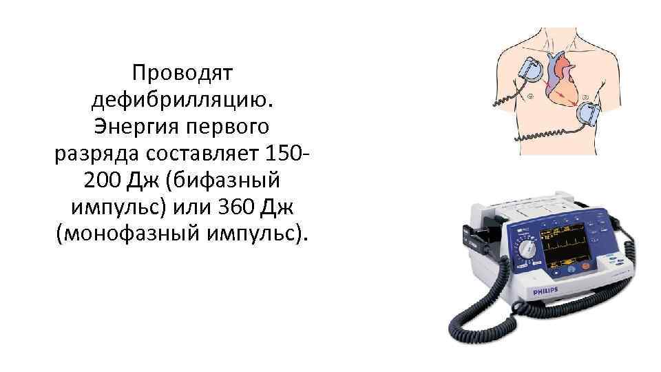 Проводят дефибрилляцию. Энергия первого разряда составляет 150200 Дж (бифазный импульс) или 360 Дж (монофазный