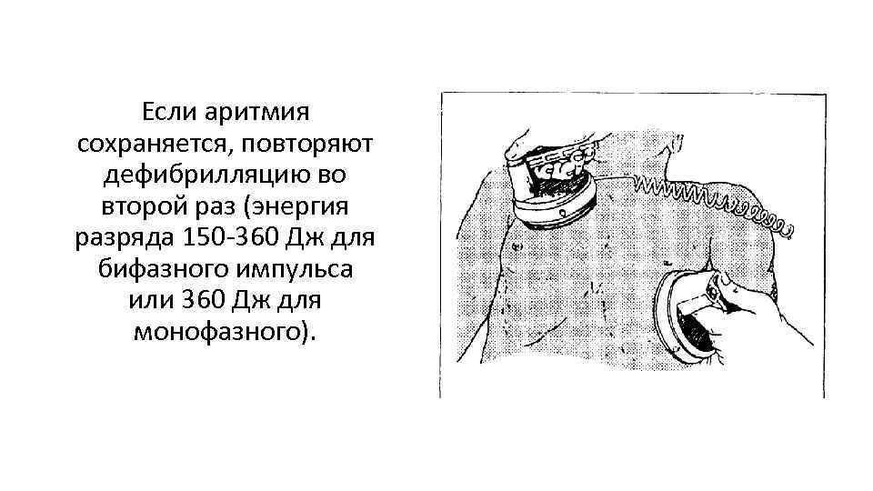 Если аритмия сохраняется, повторяют дефибрилляцию во второй раз (энергия разряда 150 -360 Дж для