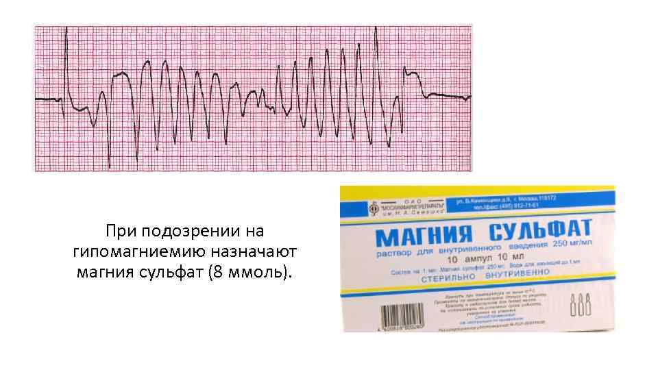 При подозрении на гипомагниемию назначают магния сульфат (8 ммоль). 
