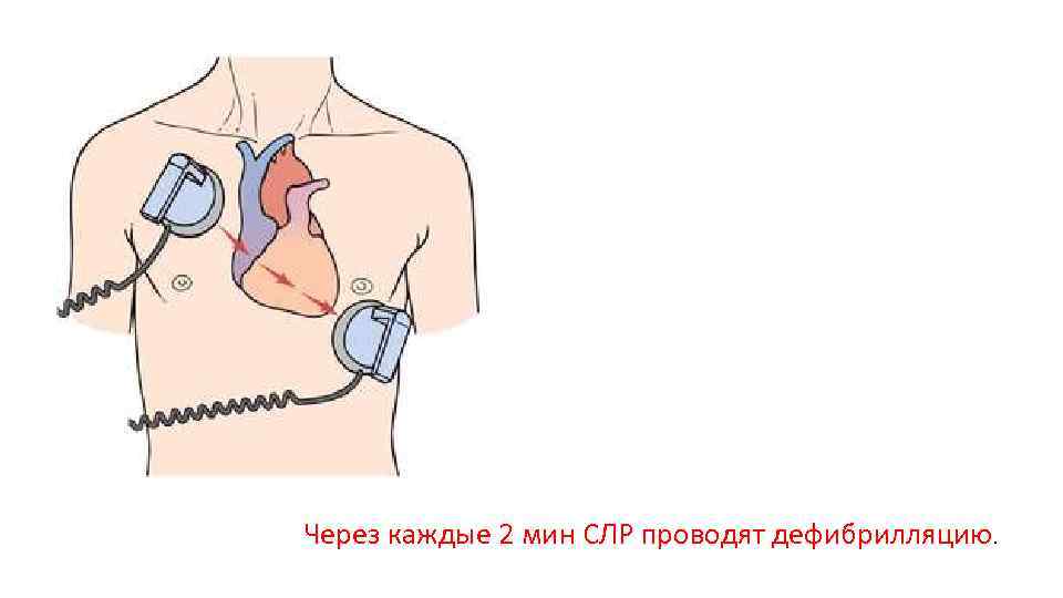 Через каждые 2 мин СЛР проводят дефибрилляцию. 
