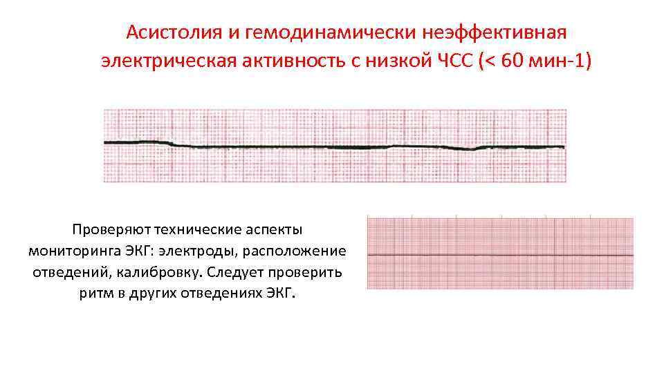 Асистолия на экг фото