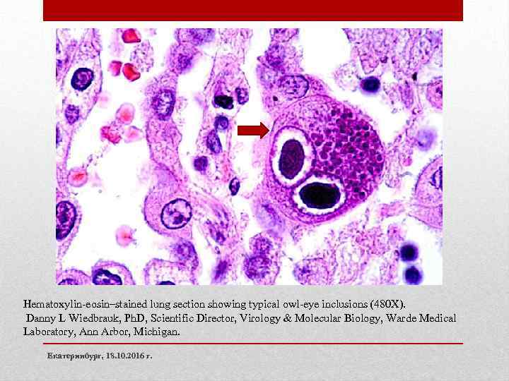 Hematoxylin-eosin–stained lung section showing typical owl-eye inclusions (480 X). Danny L Wiedbrauk, Ph. D,