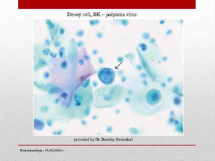 Decoy cell, BK – polyoma virus provided by Dr Dorothy Rosenthal Екатеринбург, 18. 10.