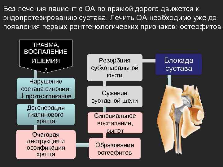 Без лечения пациент с ОА по прямой дороге движется к эндопротезированию сустава. Лечить ОА