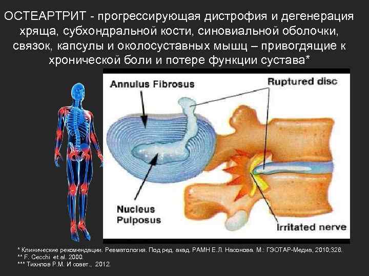 ОСТЕАРТРИТ - прогрессирующая дистрофия и дегенерация хряща, субхондральной кости, синовиальной оболочки, связок, капсулы и