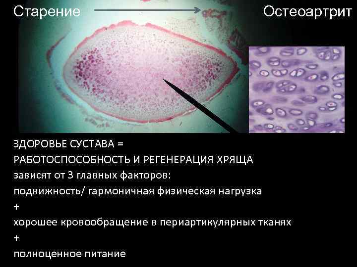 Старение Остеоартрит ЗДОРОВЬЕ СУСТАВА = РАБОТОСПОСОБНОСТЬ И РЕГЕНЕРАЦИЯ ХРЯЩА зависят от 3 главных факторов: